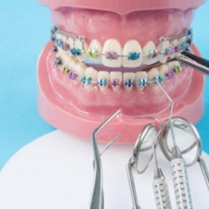 braces-teeth-whitening